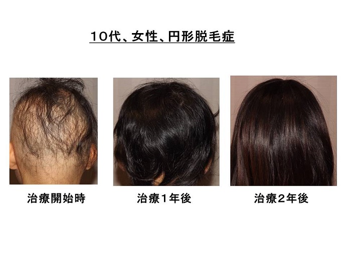 円形脱毛症　病院""
